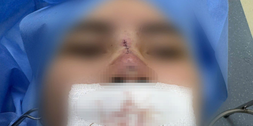 Bệnh nhân bị hoại tử mũi sau nâng mũi căng chỉ ở một cơ sở thẩm mỹ không uy tín.