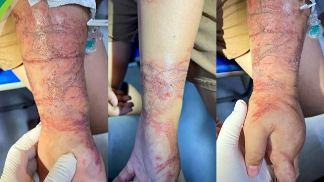 Tổn thương của bệnh nhi khi tiếp xúc với sứa biển. 