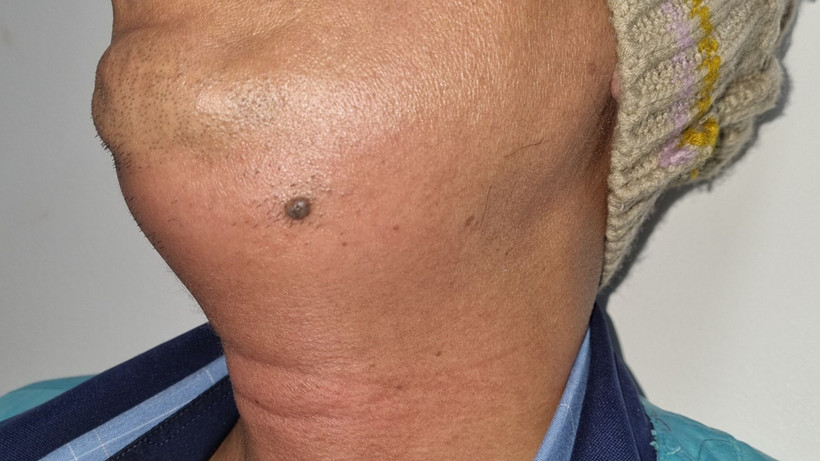 Hình ảnh sưng nề của bệnh nhân bị viêm tấy lan tỏa vùng sàn miệng.