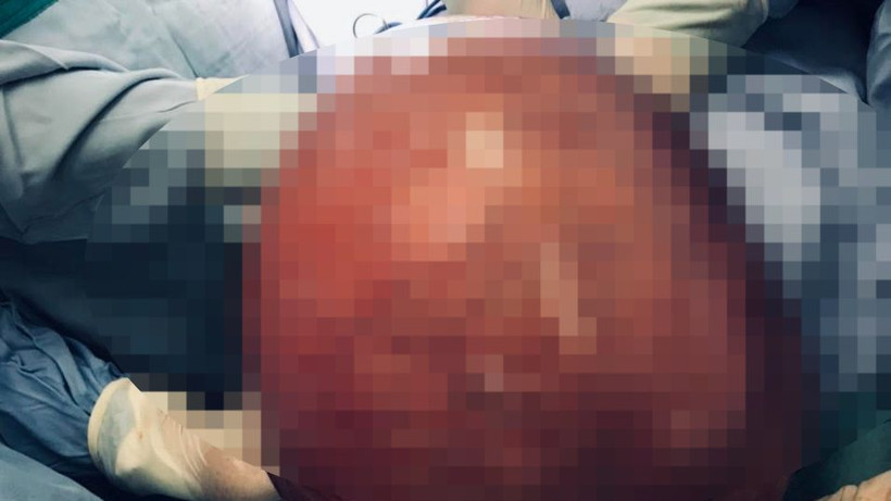 Khối u xơ tử cung nặng tới 10kg.