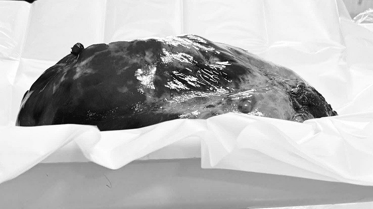 Khối u trung thất nặng 3,6kg