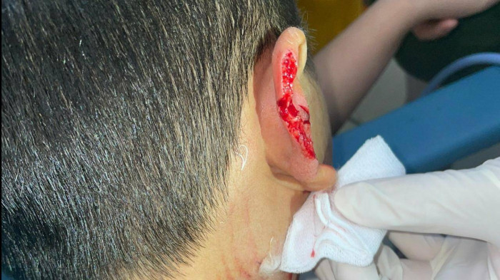 Bé N. bị chó lạ tấn công, cắn đứt vành tai.