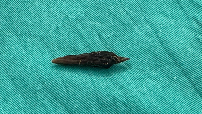 Dị vật là hạt táo đỏ gây ra tình trạng thủng ruột cho người bệnh.