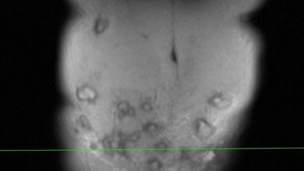 Bụng bệnh nhân có nhiều khối áp xe.