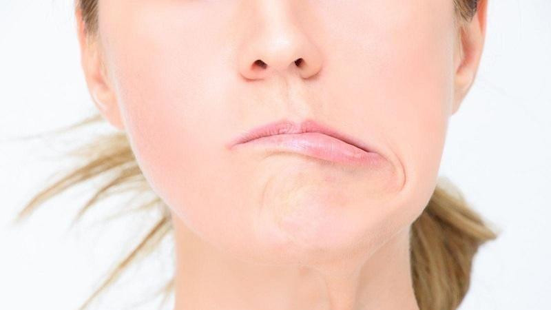 Méo miệng về một bên là triệu chứng điển hình của bệnh liệt dây thần kinh số 7. (Ảnh minh họa)