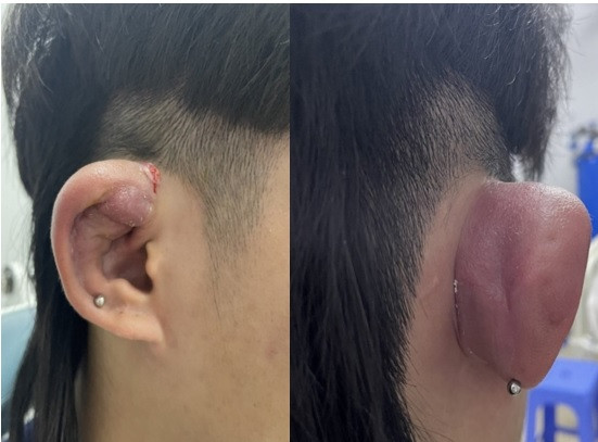 Bệnh nhân sưng nóng đỏ ở vành tai phải, có lỗ rò mủ.