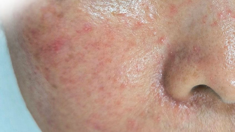 Một trường hợp bị mẩn đỏ li ti sau tự peel da tại nhà.