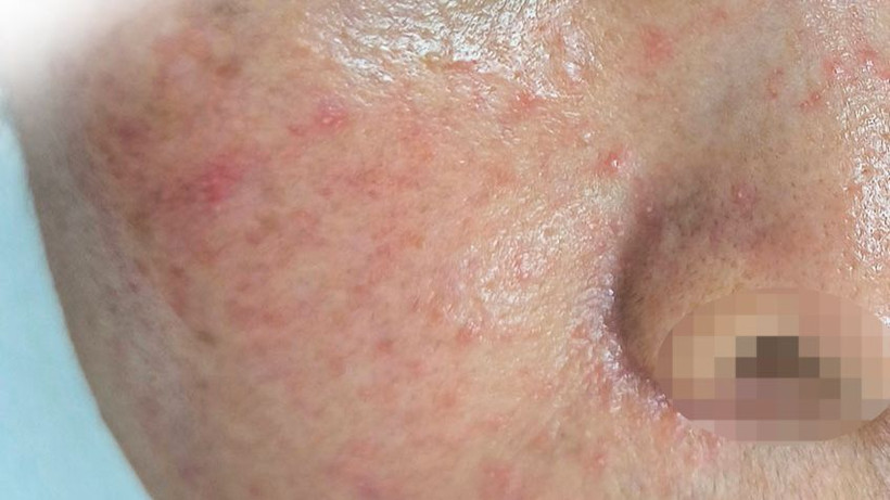 Một trường hợp bị mẩn đỏ li ti sau tự peel da tại nhà.
