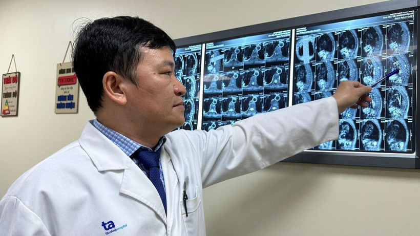Bác sĩ Bảo Ngọc đang xem xét khối u của ông L. nằm trọn trong ống sống ngực. 