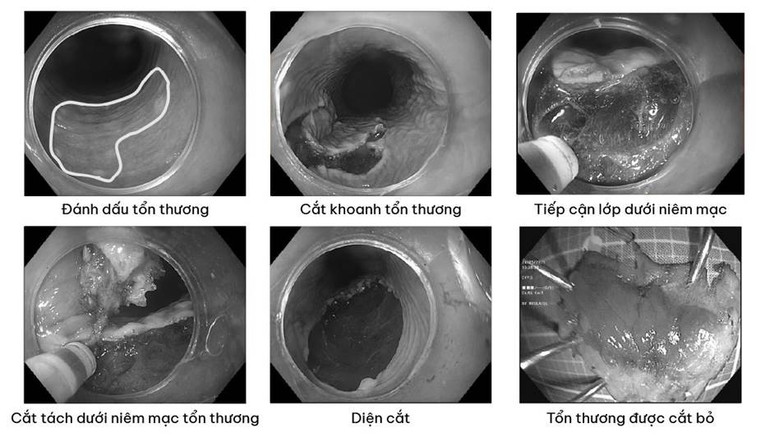 Tổn thương được loại bỏ bằng kỹ thuật xâm lấn tối thiểu - cắt tách dưới niêm mạc (ESD). Tổn thương được loại bỏ bằng kỹ thuật xâm lấn tối thiểu - cắt tách dưới niêm mạc (ESD).