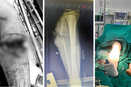 5 giờ phẫu thuật nghẹt thở cho nam sinh 15 tuổi đứt cẳng chân