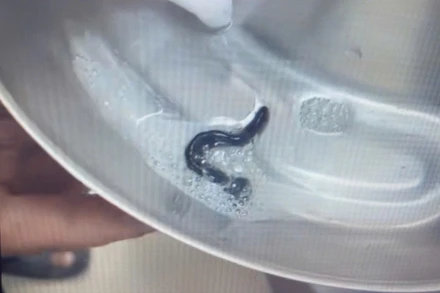 Con đỉa sau khi được gắp ra khỏi đường thở của bệnh nhi Y.V.N .