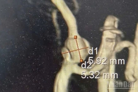 Ghi nhận bệnh nhân Sơn Phương có túi phình động mạch đốt sống kích thước khoảng 5,92x5,32mm.