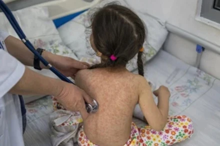 Một bé gái mắc bệnh sởi. (Ảnh minh họa: WHO)