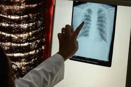 Bệnh lao quay trở lại châu Âu với tốc độ đáng lo ngại