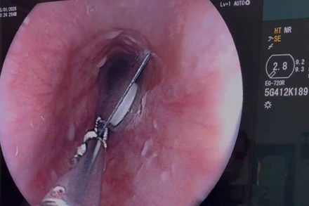 Viên thuốc còn nguyên bao kẽm kẹt trong thực quản người bệnh.