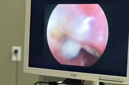 Thiết bị nội soi của Bệnh viện Sản-Nhi Cà Mau giúp phát hiện dị vật trong cơ thể của trẻ. (Ảnh do bệnh viện cung cấp)