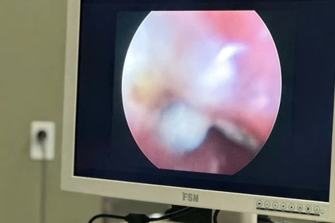 Thiết bị nội soi của Bệnh viện Sản-Nhi Cà Mau giúp phát hiện dị vật trong cơ thể của trẻ. (Ảnh do bệnh viện cung cấp)