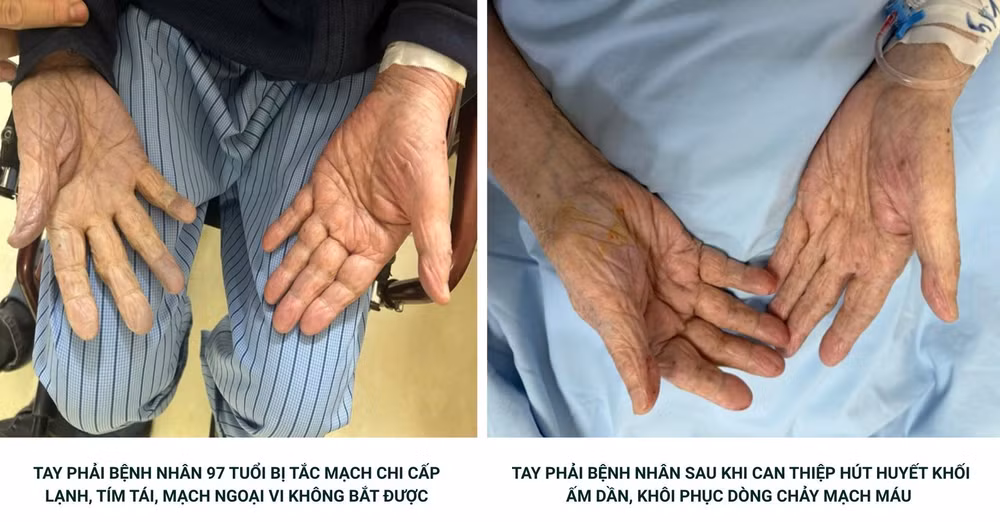 Hút nhiều cục máu đông giúp bệnh nhân 97 tuổi tránh nguy cơ hoại tử
