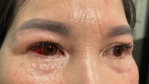 Mắt phải bị viêm kết mạc cấp.