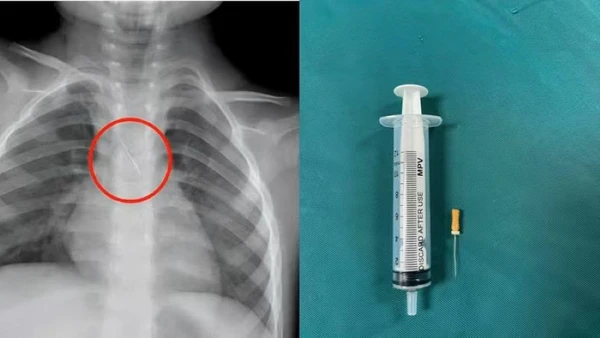 Dị vật trong đường thở của bệnh nhi. (Ảnh: Bệnh viện Đa khoa tỉnh Quảng Trị)