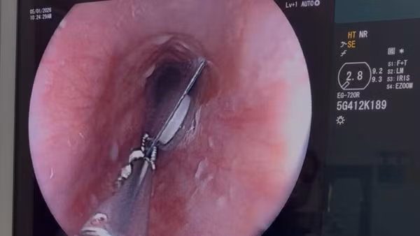 Viên thuốc còn nguyên bao kẽm kẹt trong thực quản người bệnh.