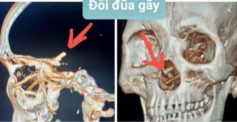 Hình ảnh chụp CT Scanner sọ não phát hiện đôi đũa trong mũi bệnh nhân. (Ảnh: Bệnh viện cung cấp)