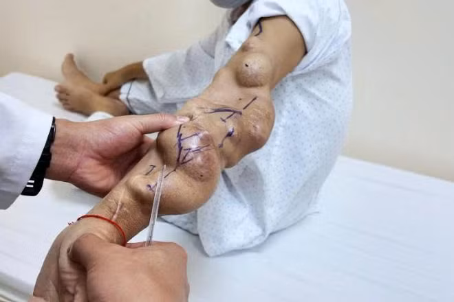 Các khối phình phát triển liên tiếp trên cầu nối AVF khiến cánh tay biến dạng, thành mạch căng mỏng và dọa vỡ bất cứ lúc nào. 