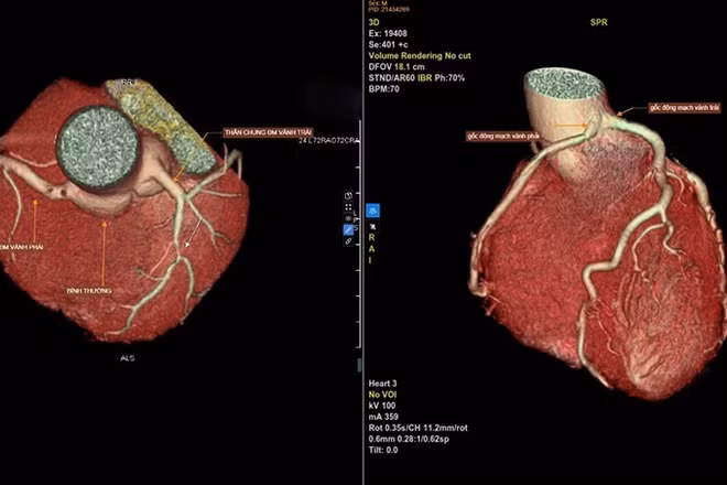 Hình ảnh chụp CTA 3D. Bên trái là động mạch vành bình thường. Bên phải là hình ảnh hai nhánh động mạch vành trái và phải xuất phát chung từ một gốc.