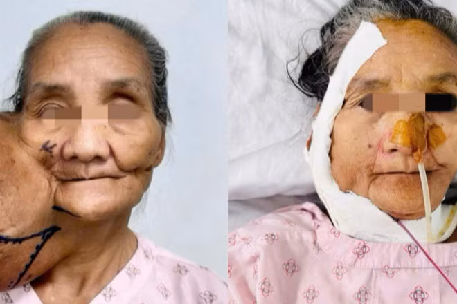Bệnh nhân đã được phẫu thuật loại bỏ khối u khổng lồ. 