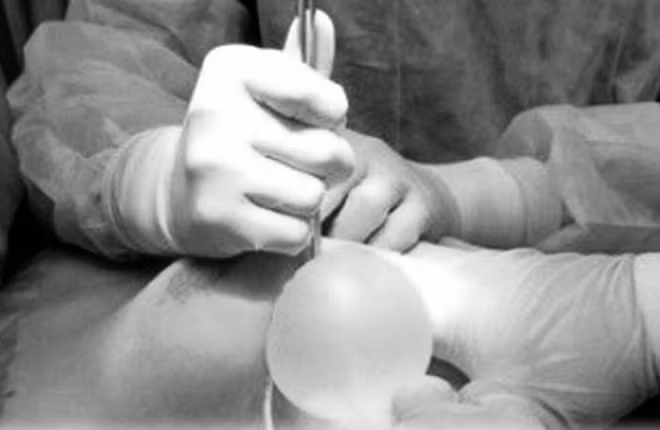 Các bác sĩ thực hiện phẫu thuật hút dịch mủ ngực cho bệnh nhân.
