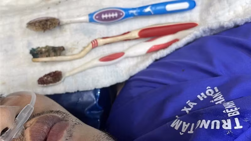 Ba chiếc bàn chải được lấy khỏi bụng bệnh nhân.