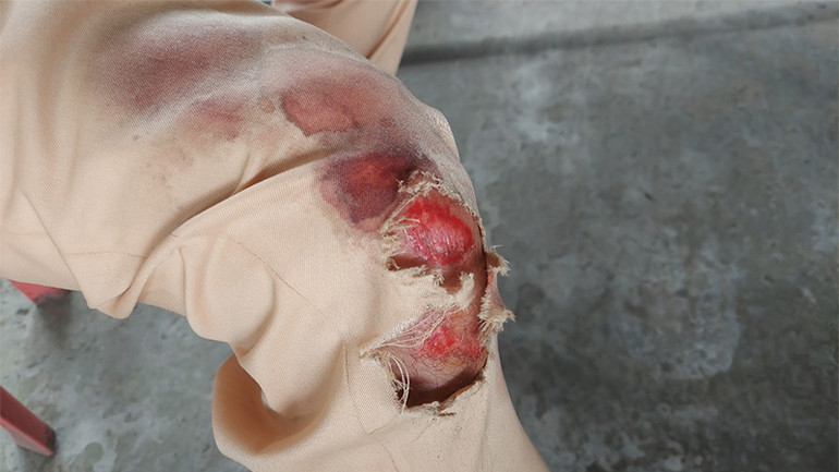 Quá trình truy bắt 3 đối tượng, 1 đồng chí Cảnh sát giao thông tỉnh Đồng Tháp bị xây xát ở chân. (Ảnh: Công an cung cấp)