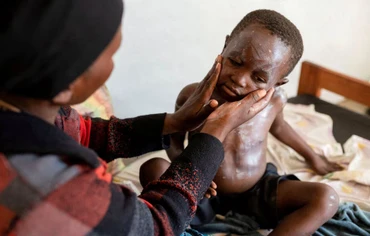 Một bệnh nhân đậu mùa khỉ đang được bôi thuốc lên da. Ảnh Reuters.