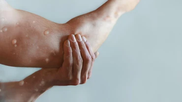 Một bệnh nhân mắc bệnh đậu mùa khỉ. (Ảnh: iStock)