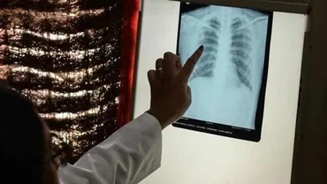 Bệnh lao đã trở lại là căn bệnh truyền nhiễm nguy hiểm nhất trên thế giới. (Ảnh: AFP/TTXVN)