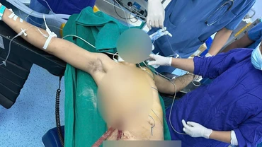 Nam thanh niên với vết thương thấu bụng-ngực do tai nạn lao động.