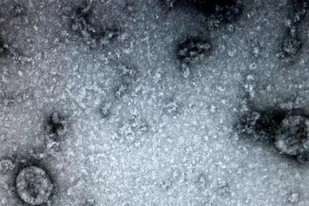 Các nhà nghiên cứu từ Đại học Y khoa Sechenov của Nga cảnh báo những người từng bị nhiễm virus SARS-CoV-2 đều có thể mắc một căn bệnh nguy hiểm: Hoại tử xương. (Ảnh: TTXVN)