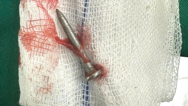 Cái đinh được bác sĩ phẫu thuật lấy ra từ ruột non của bệnh nhân.