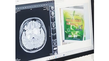 Hình ảnh não bị tổn thương và sản phẩm trà uống giảm cân mà bệnh nhân đã sử dụng.