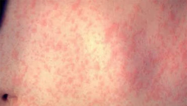 Bùng phát dịch sởi tại Mỹ, CDC ban bố cảnh báo đi lại