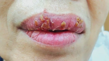 Nhiễm trùng môi vì làm đẹp cấp tốc 