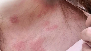 Tổn thương do kiến ba khoang. 