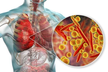 Viêm phổi do mycoplasma là một bệnh nhiễm trùng ở phổi khá phổ biến.