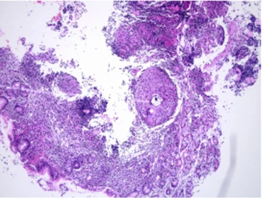 Hình ảnh xét nghiệm mô bệnh học cho kết quả tổn thương viêm hạt hướng đến do Mycobacterium.