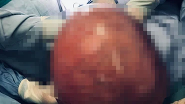 Khối u xơ tử cung nặng tới 10kg.