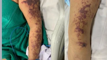 Bệnh nhân có tổn thương da dạng ban tím toàn thân.