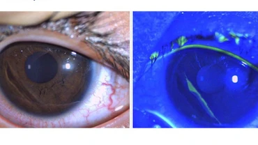 Hình ảnh trợt biểu mô giác mạc ở bệnh nhi 4 tuổi qua quan sát bằng sinh hiển vi có nhuộm soi Fluorescein (ảnh phải).
