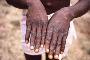Bệnh nhân mắc đậu mùa khỉ tại Cộng hòa dân chủ Congo. (Ảnh: AFP/TTXVN)