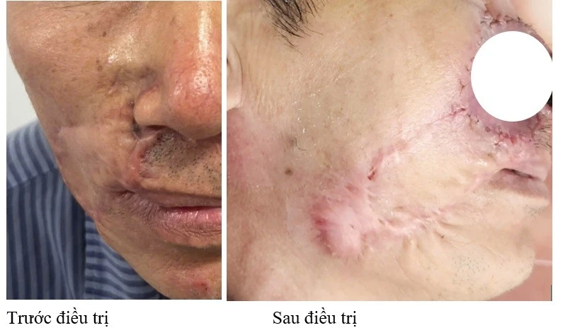 Ung thư da tái phát nhiều lần dù đã phẫu thuật: Cảnh báo từ ca bệnh phức tạp